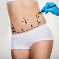 The Truth About Tummy Tuck Complications: An Expert's Perspective