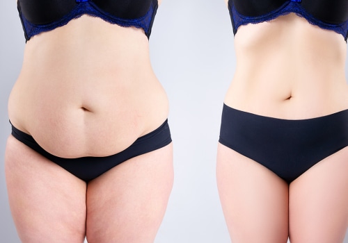 The Impact of Tummy Tuck Procedures on Patient Satisfaction