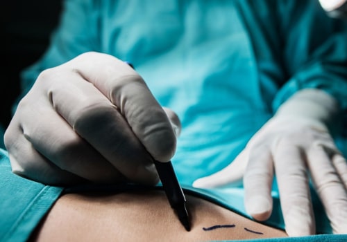 Top Benefits Of Choosing Invisible Bra Surgery In Cosmetic Procedures