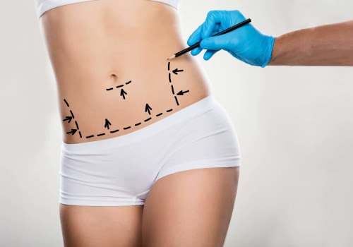 The Truth About Tummy Tuck Complications: An Expert's Perspective